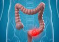 Surgeons warn against ignoring dangerous symptoms of colorectal cancer