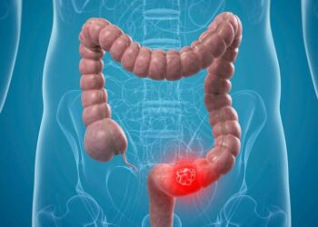Surgeons warn against ignoring dangerous symptoms of colorectal cancer