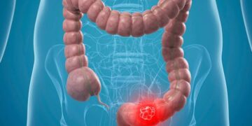 Surgeons warn against ignoring dangerous symptoms of colorectal cancer