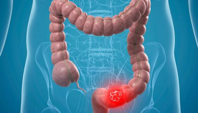 Surgeons warn against ignoring dangerous symptoms of colorectal cancer
