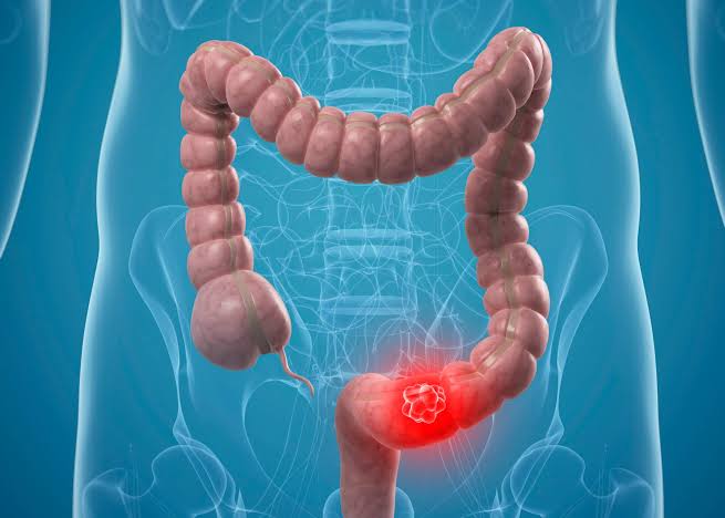 Surgeons warn against ignoring dangerous symptoms of colorectal cancer