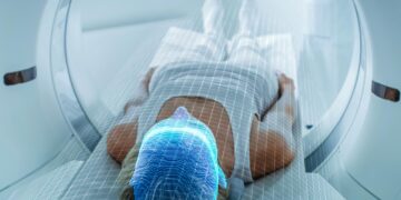 Second PSMA PET scan finds hidden prostate cancer in 56% of patients